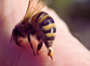 درمان نیش زنبور عسل